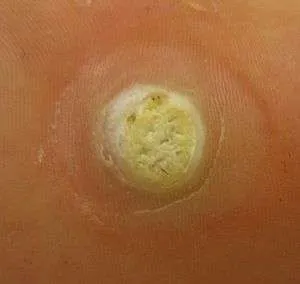 plantar wart