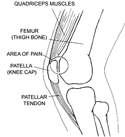 Runner's Knee