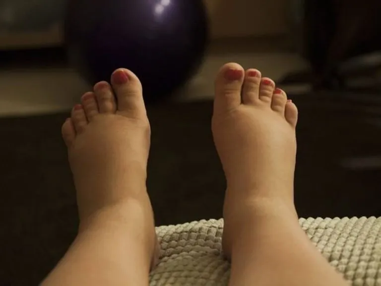 Home Remedies For Swollen Feet