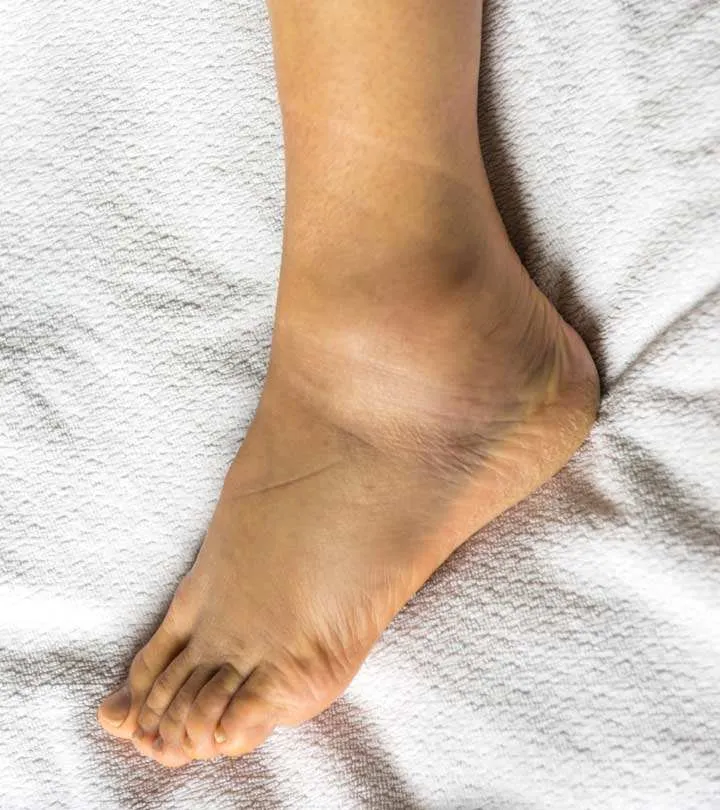 Home Remedies For Swelling in Legs