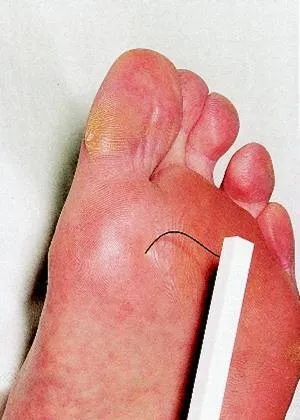 Five Steps to Prevent Diabetic Foot Problems