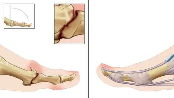 Treatments For Hallux Rigidus