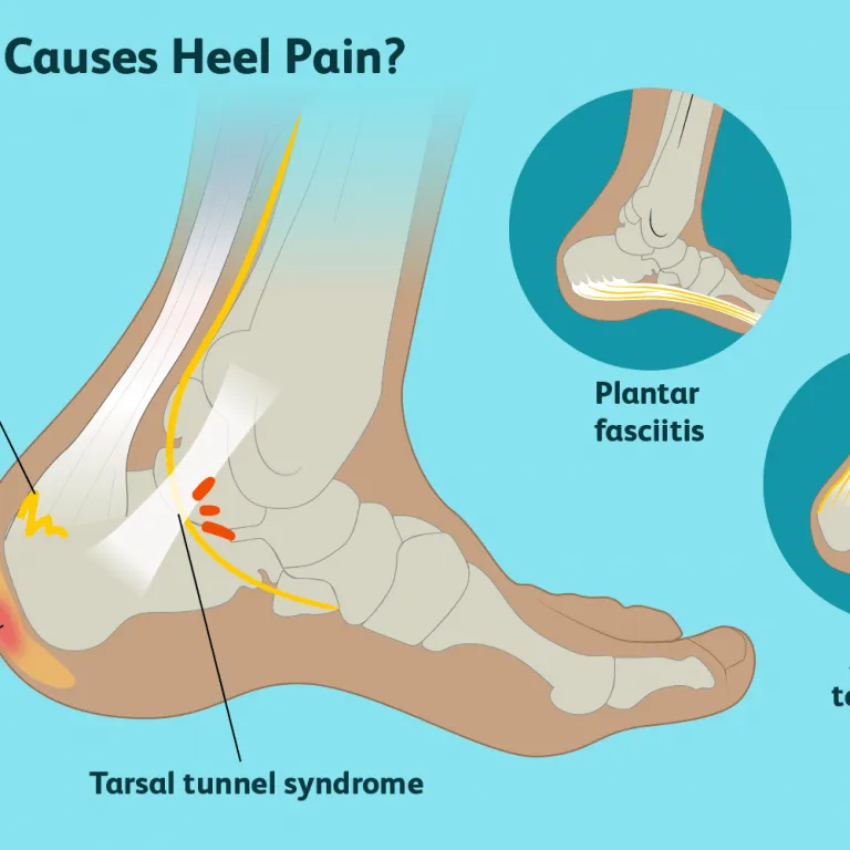 When to See a Doctor For Plantar Fasciitis