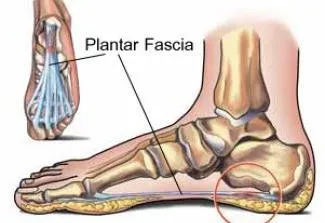 Different Stages of Plantar Fasciitis
