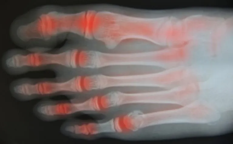 What Are the Signs of Arthritis in Your Feet?