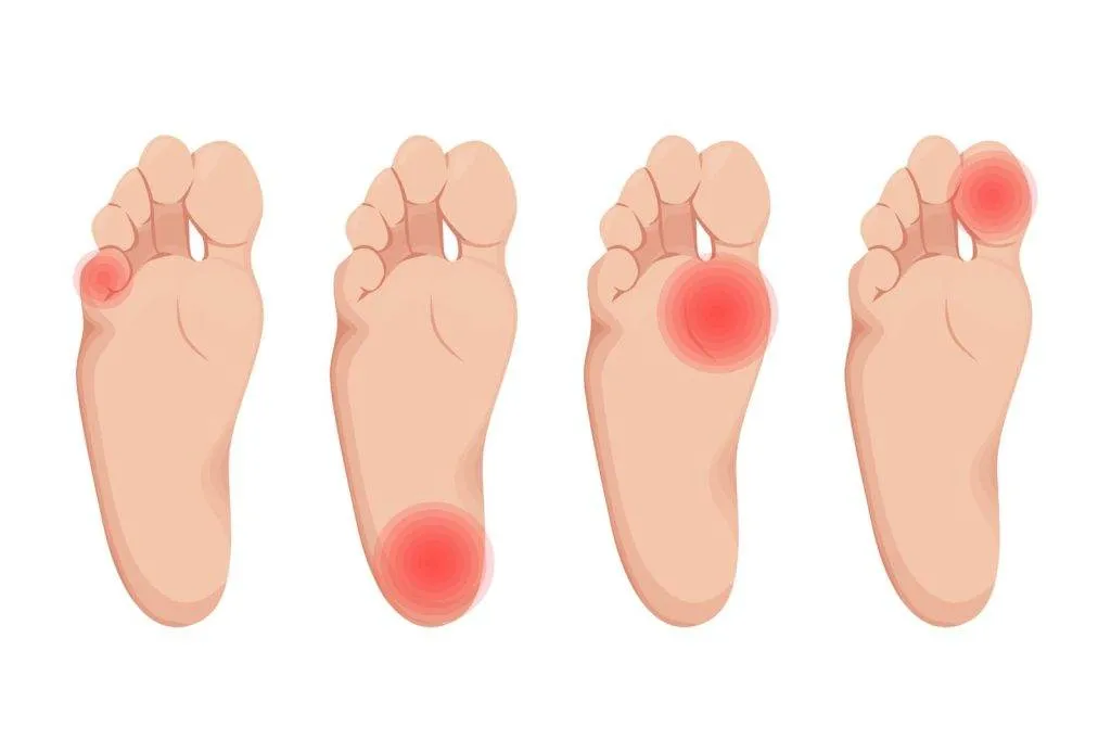 Plantar Fasciitis cures