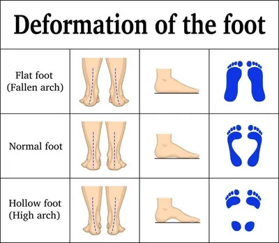 Causes of Foot Pain When Walking