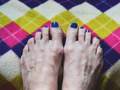 What Causes Metatarsalgia?