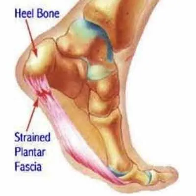 How Bad Can Plantar Fasciitis Get?