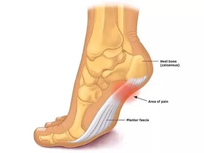 Fastest Way to Cure Plantar Fasciitis