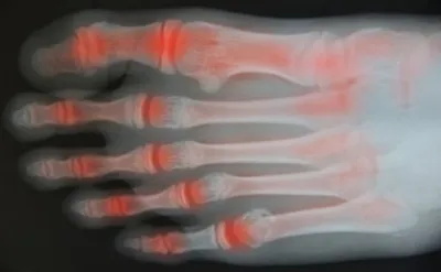 What Are the Signs of Arthritis in Your Feet?