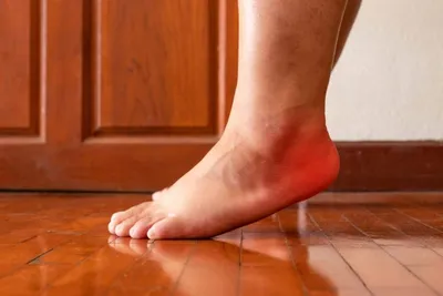 What Triggers Plantar Fasciitis